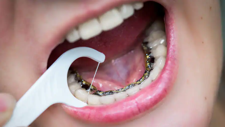 braces